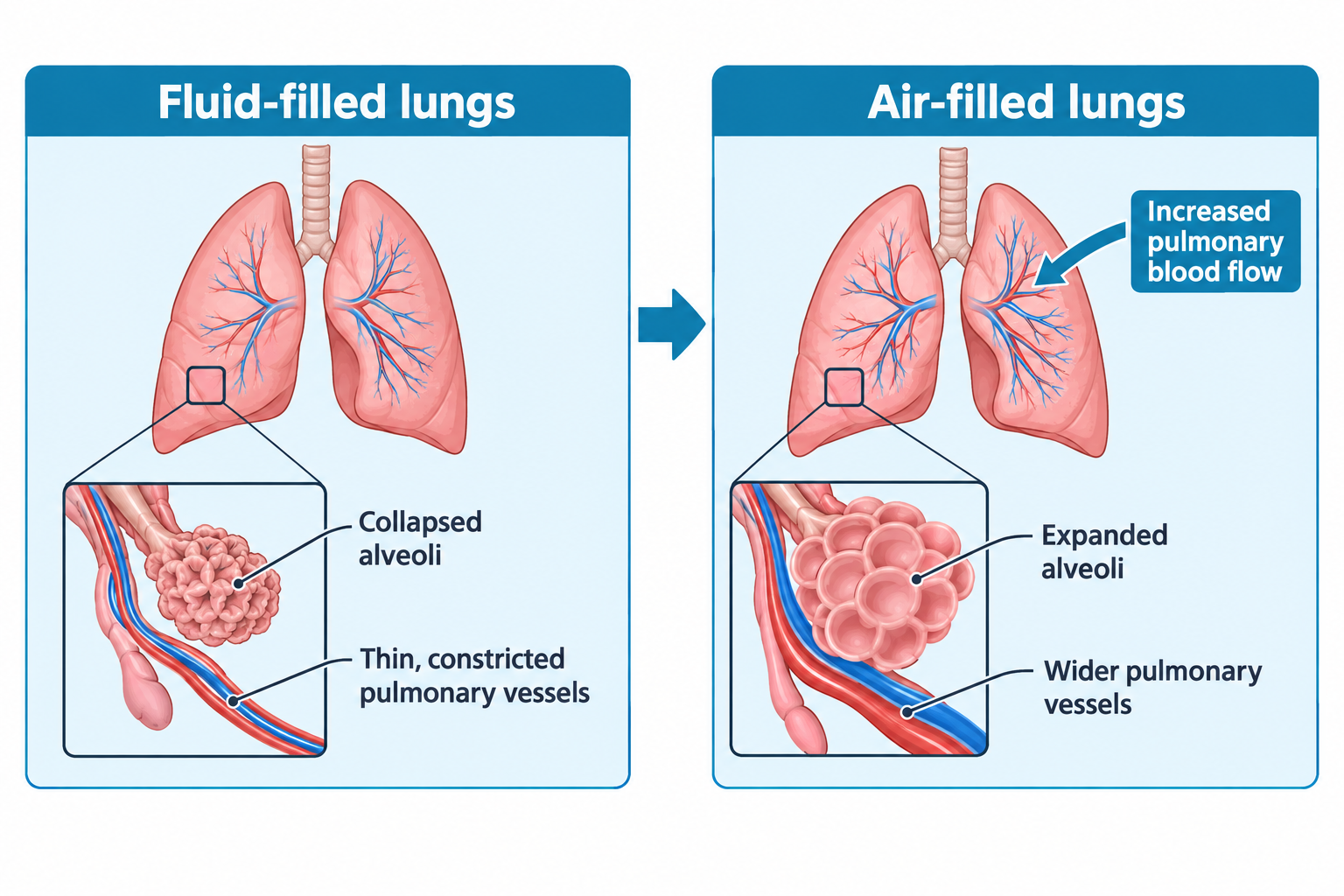 Two labeled lung diagrams comparing fluid-filled lungs before birth to air-filled lungs after the first breath: the left panel shows collapsed, clustered alveoli with thin, constricted pulmonary vessels, while the right panel shows expanded, rounded alveoli with wider pulmonary vessels and an arrow indicating increased pulmonary blood flow into the lung.