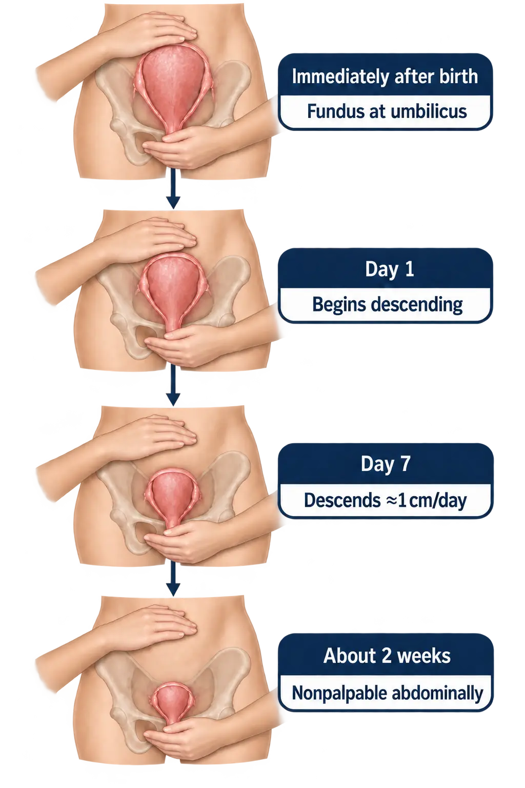 Four-stage sequence of uterine fundal position shrinking within the pelvis after childbirth: immediately after birth the fundus is at the umbilicus, day 1 it begins descending, by day 7 it has descended about 1cm per day, and by about 2 weeks it is nonpalpable abdominally.