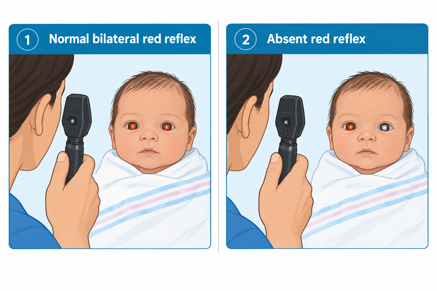 Two side-by-side panels show a clinician using an ophthalmoscope to check a swaddled newborn's red reflex. Panel 1, labeled 'Normal bilateral red reflex,' shows both of the infant's pupils glowing orange-red. Panel 2, labeled 'Absent red reflex,' shows one pupil still glowing red while the other pupil appears white instead of red, illustrating an abnormal finding.
