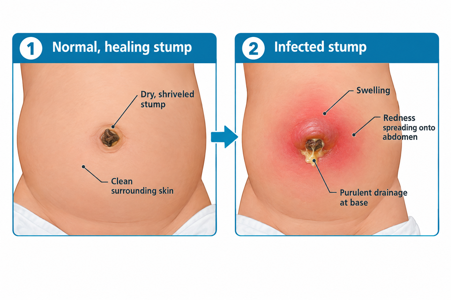 Side-by-side comparison of a newborn's umbilicus: the left panel shows a normal healing stump that is dry, shriveled, and dark brown with clean surrounding skin; the right panel shows an infected stump with surrounding swelling, redness spreading onto the abdomen, and yellowish purulent drainage at the base.