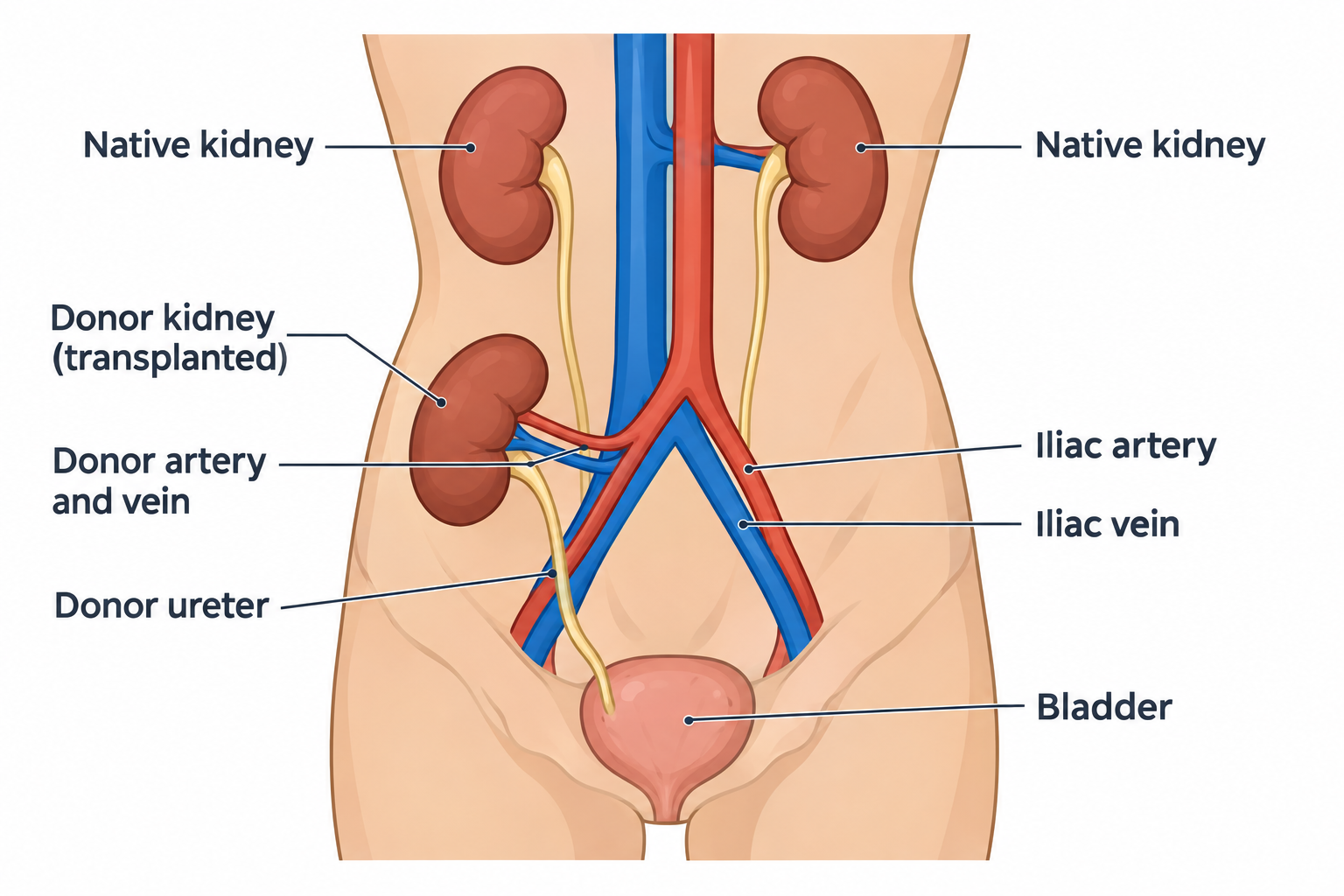 Cross-section of a lower abdomen showing two native kidneys higher up connected to the aorta and vena cava, and a transplanted donor kidney placed lower in the pelvis, with its donor artery and vein joined to the iliac artery and vein, the donor ureter running down to the bladder.