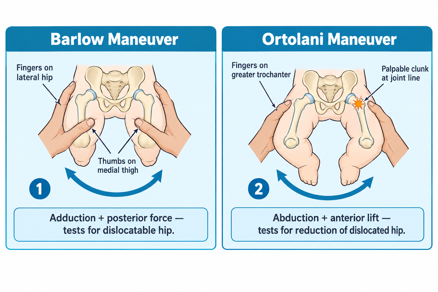 Two panels compare hip-dislocation screening maneuvers on a newborn model. Left panel (Barlow): examiner's fingers rest on the lateral hip and thumbs on the medial thigh while adducting the legs with posterior pressure, testing whether the hip can be dislocated. Right panel (Ortolani): examiner's fingers rest over the greater trochanter while abducting the legs with an anterior lift, producing a palpable clunk at the joint line as a dislocated hip reduces.