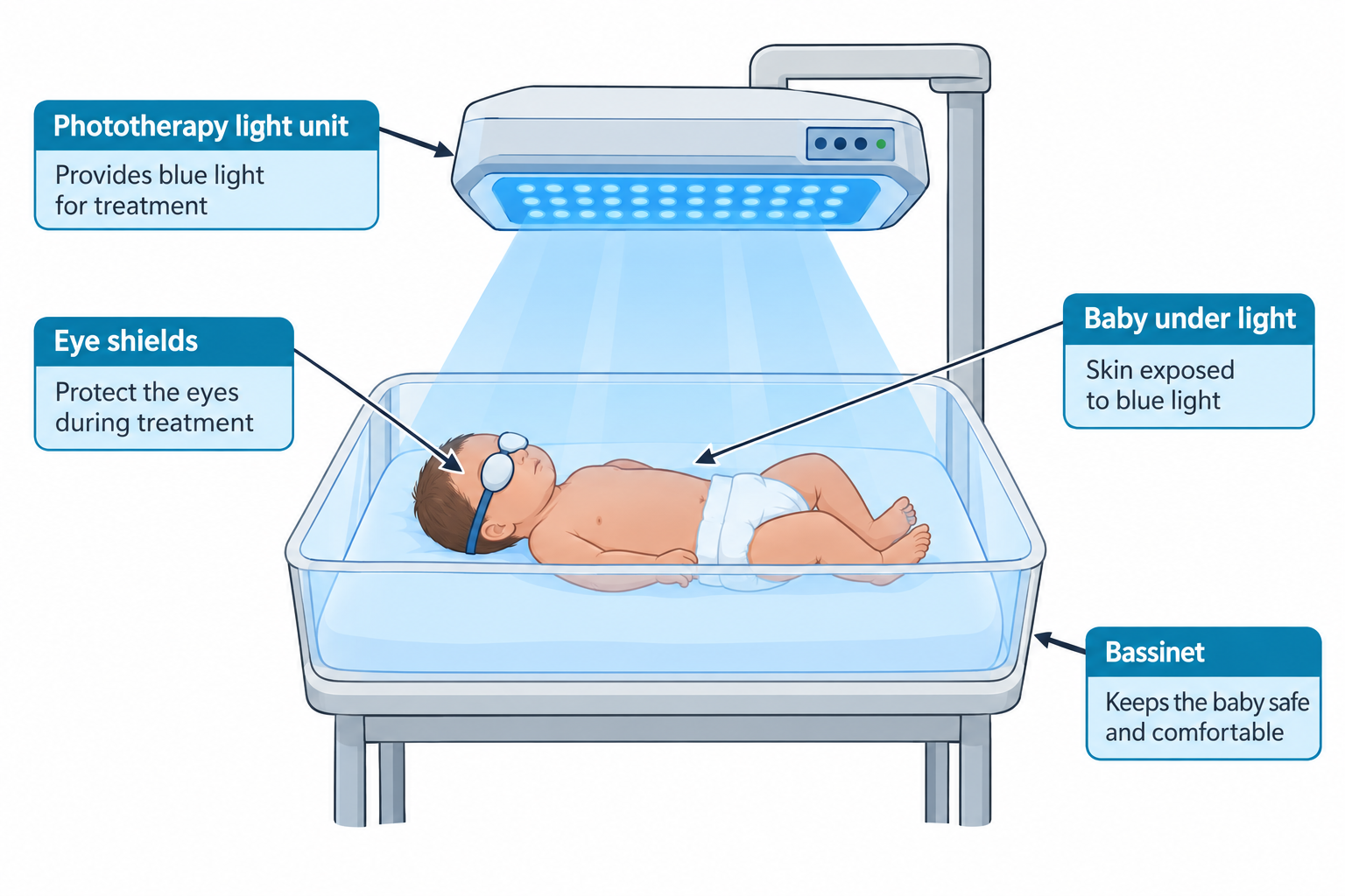 An infant lying on their back in a bassinet wearing only a diaper, with soft eye shields covering the eyes, under a ceiling-mounted phototherapy light unit that projects blue light onto the baby's skin; labeled callouts identify the phototherapy light unit, eye shields, baby under the light with skin exposed, and the bassinet that keeps the baby safe and comfortable.