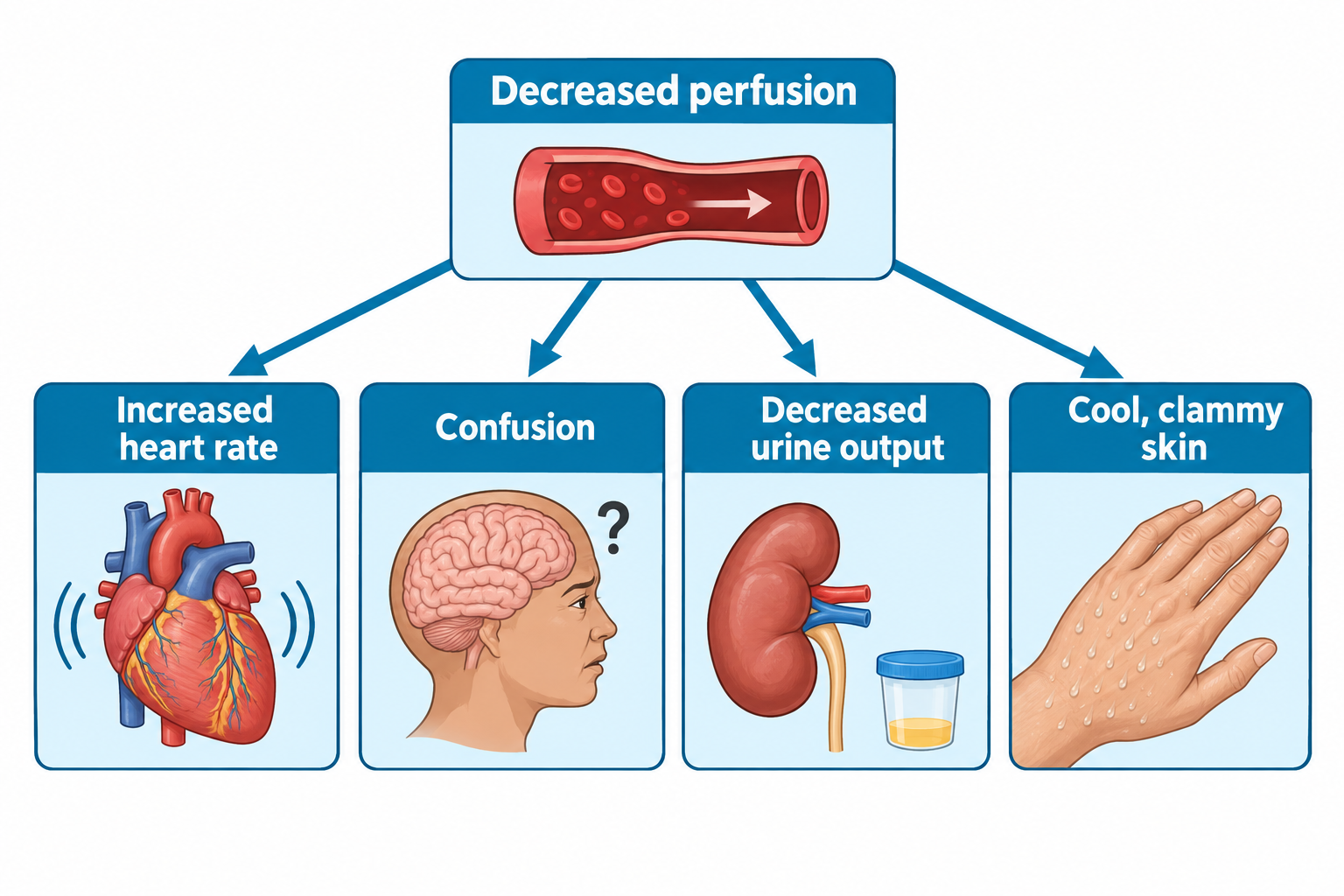 A flow diagram shows a blood vessel labeled Decreased perfusion with arrows branching to four panels: a heart labeled Increased heart rate, a brain in profile with a question mark labeled Confusion, a kidney with a urine collection cup labeled Decreased urine output, and a hand with visible sweat droplets labeled Cool, clammy skin.