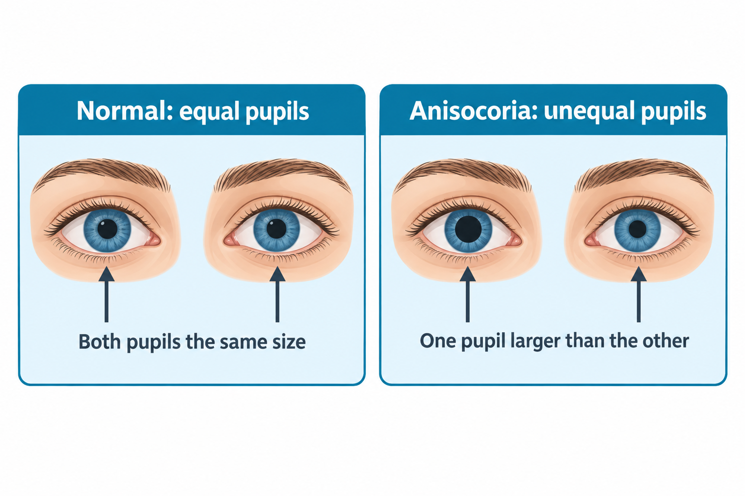 Two side-by-side panels comparing pupil size. The left panel labeled 'Normal: equal pupils' shows two eyes with pupils of the same size, with an arrow pointing to each pupil and the caption 'Both pupils the same size.' The right panel labeled 'Anisocoria: unequal pupils' shows two eyes where one pupil is visibly larger than the other, with arrows pointing to each pupil and the caption 'One pupil larger than the other.'
