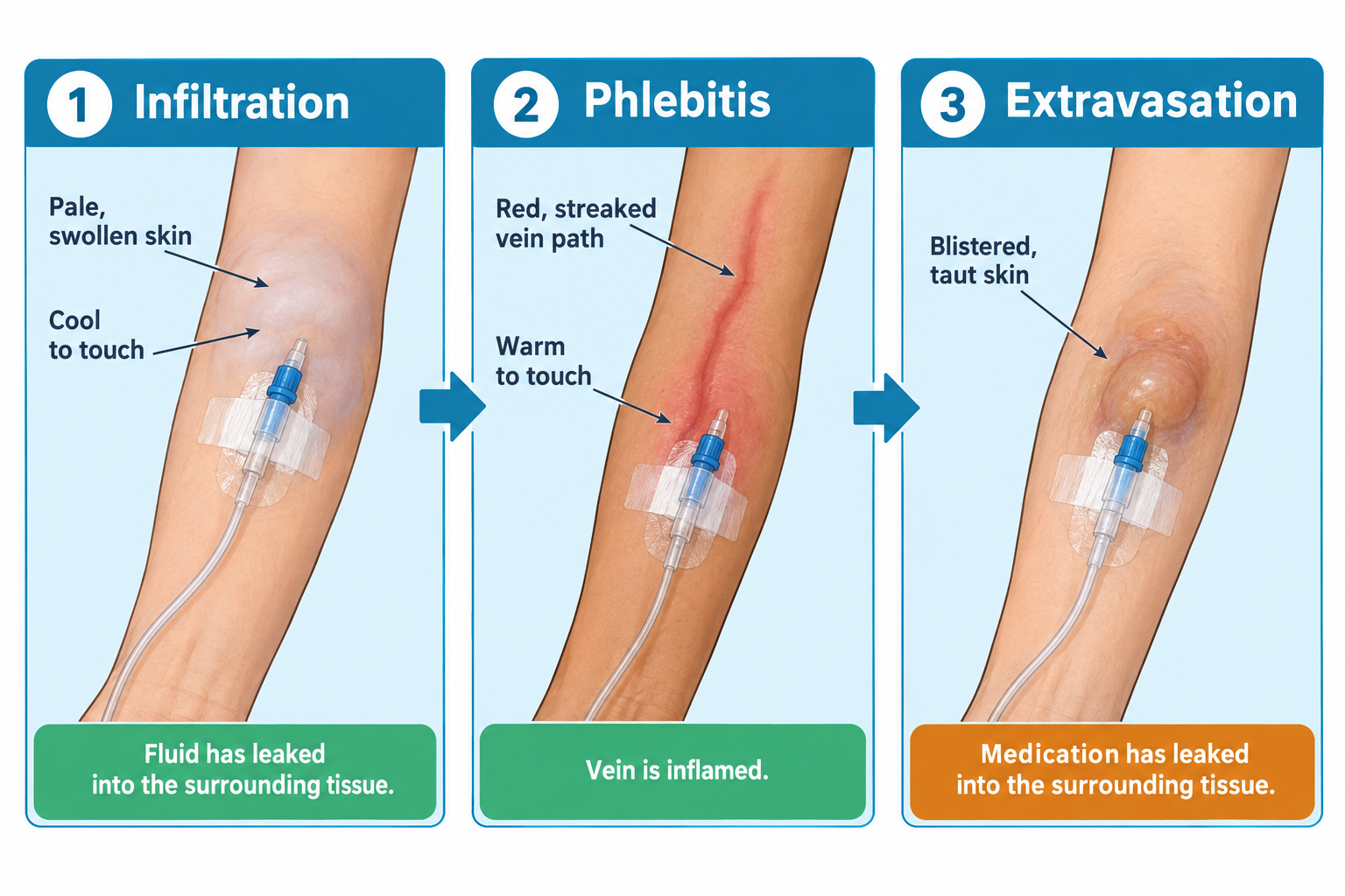 Three side-by-side images of a forearm with an IV catheter taped in place, illustrating IV complications: Panel 1, Infiltration, shows pale, swollen skin that is cool to touch, with the caption 'Fluid has leaked into the surrounding tissue.' Panel 2, Phlebitis, shows a red, streaked path along the vein that is warm to touch, with the caption 'Vein is inflamed.' Panel 3, Extravasation, shows a raised, blistered area of taut skin at the IV site, with the caption 'Medication has leaked into the surrounding tissue.'
