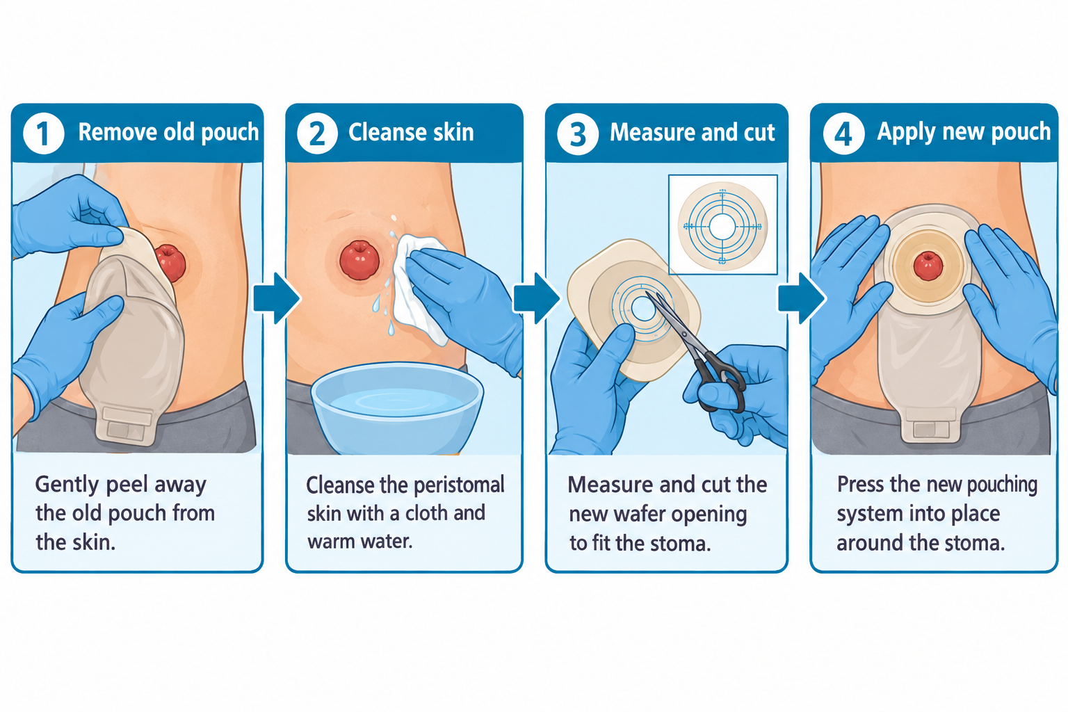 A four-panel sequence demonstrating ostomy pouch care: panel 1 shows gloved hands gently peeling an old pouch away from the skin around a reddish, protruding stoma; panel 2 shows a gloved hand cleansing the peristomal skin with a cloth and a bowl of warm water; panel 3 shows a wafer being measured and cut with scissors using a concentric-circle sizing guide to match the stoma; panel 4 shows gloved hands pressing the new pouching system into place around the stoma.