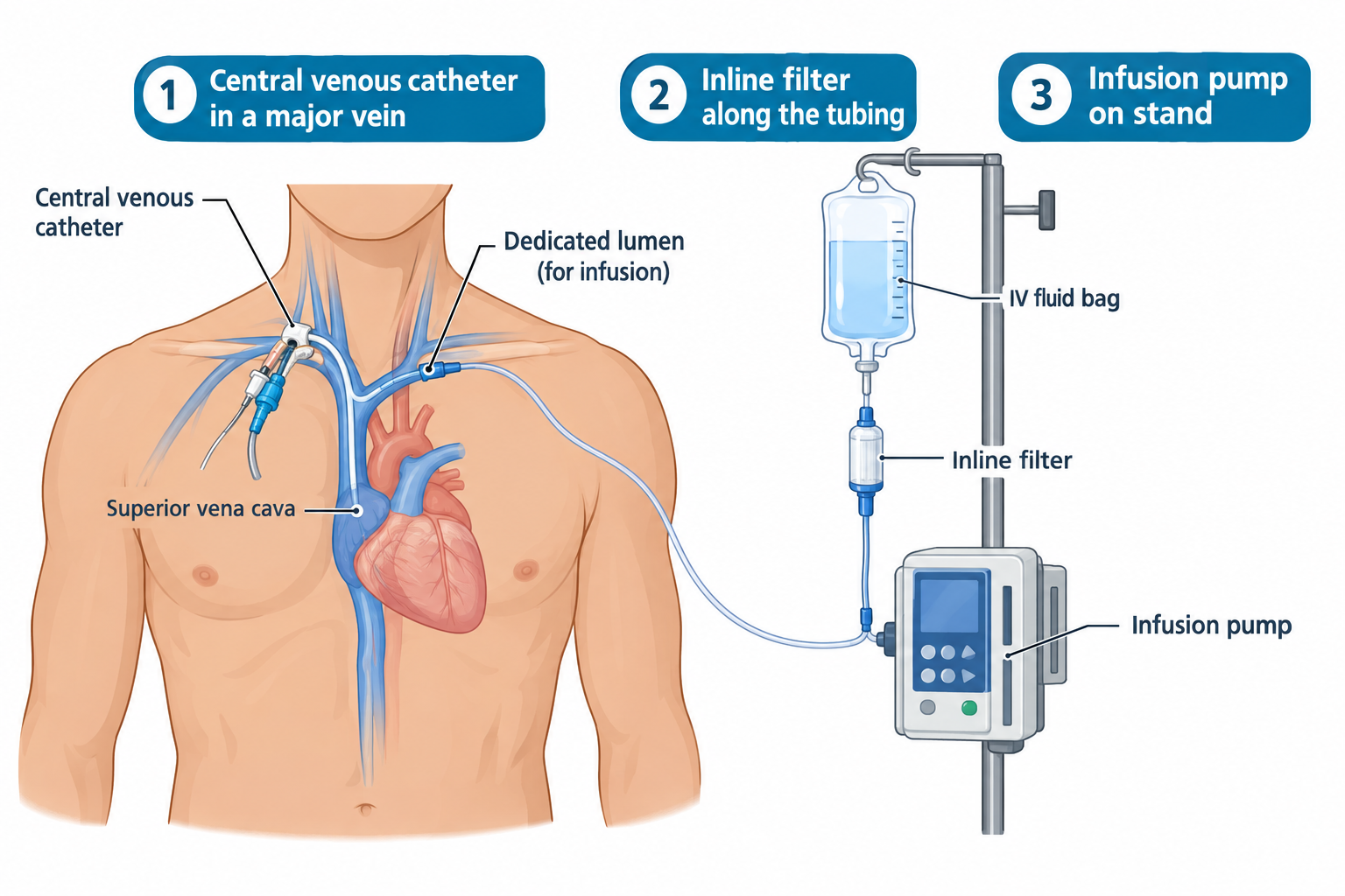 A three-panel diagram of safe parenteral nutrition administration. Panel 1 shows a central venous catheter inserted into a chest vein and threaded to the superior vena cava near the heart, with a dedicated lumen labeled for infusion. Panel 2 shows an IV fluid bag connected through an inline filter along the tubing. Panel 3 shows the tubing continuing to an infusion pump mounted on an IV pole stand.