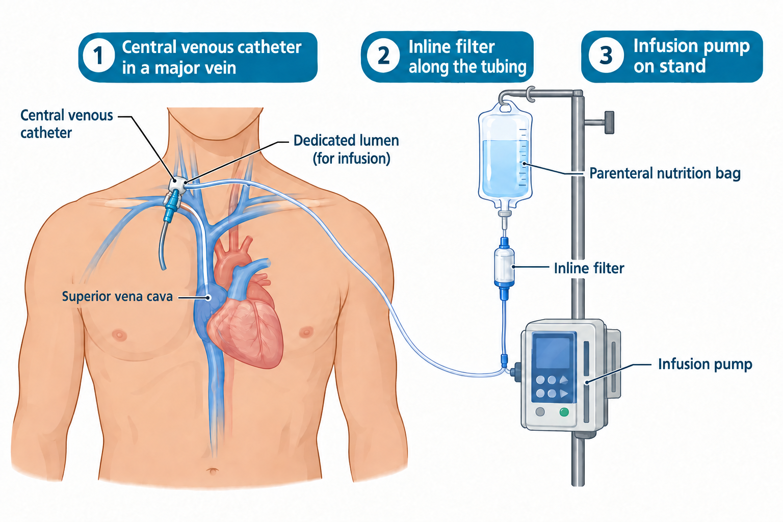 A three-panel illustration of parenteral nutrition administration: a central venous catheter is inserted near the shoulder/neck and threaded through a major vein into the superior vena cava near the heart, with a dedicated lumen for infusion; the tubing runs to a hanging parenteral nutrition bag through an inline filter; the tubing then continues to an infusion pump mounted on an IV pole stand.