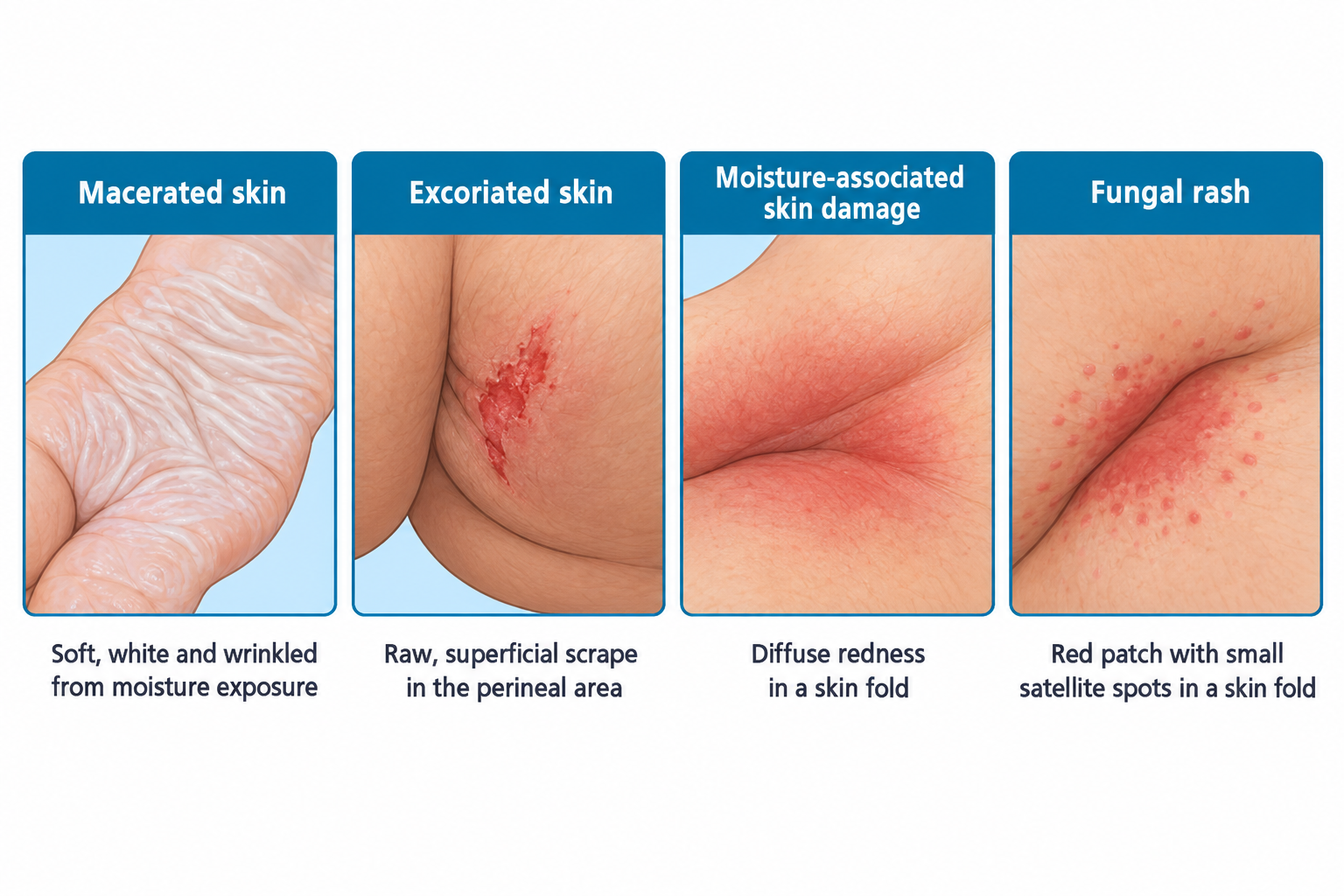 Four side-by-side close-up photos of skin: soft, white, wrinkled skin from moisture exposure (maceration); a raw, superficial red scrape in a skin fold (excoriation); diffuse redness in a skin fold (moisture-associated skin damage); and a red patch with small satellite spots in a skin fold (fungal rash).