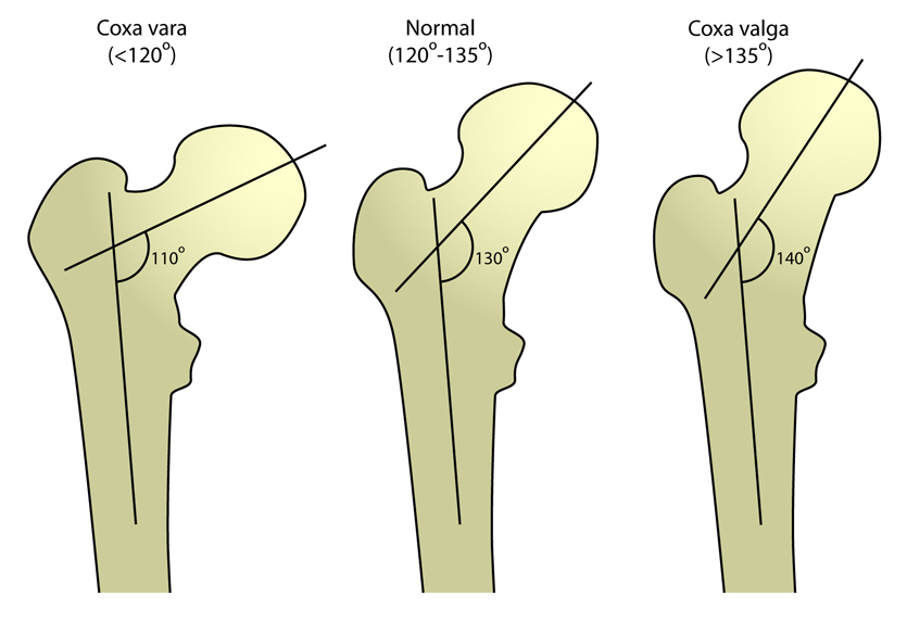 Angle of inclination of hip