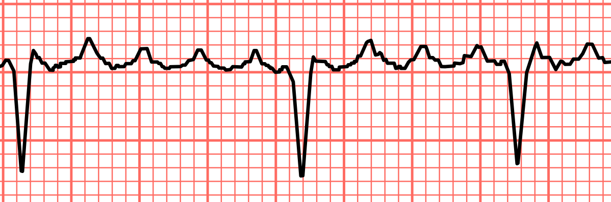 Atrial flutter