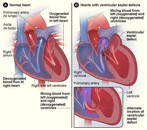 Congenital heart defects