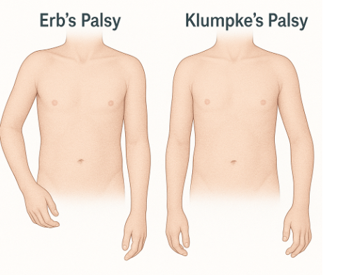 Erb’s and Klumpke’s palsy