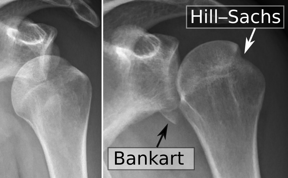 Hills sachs and Bankart lesions