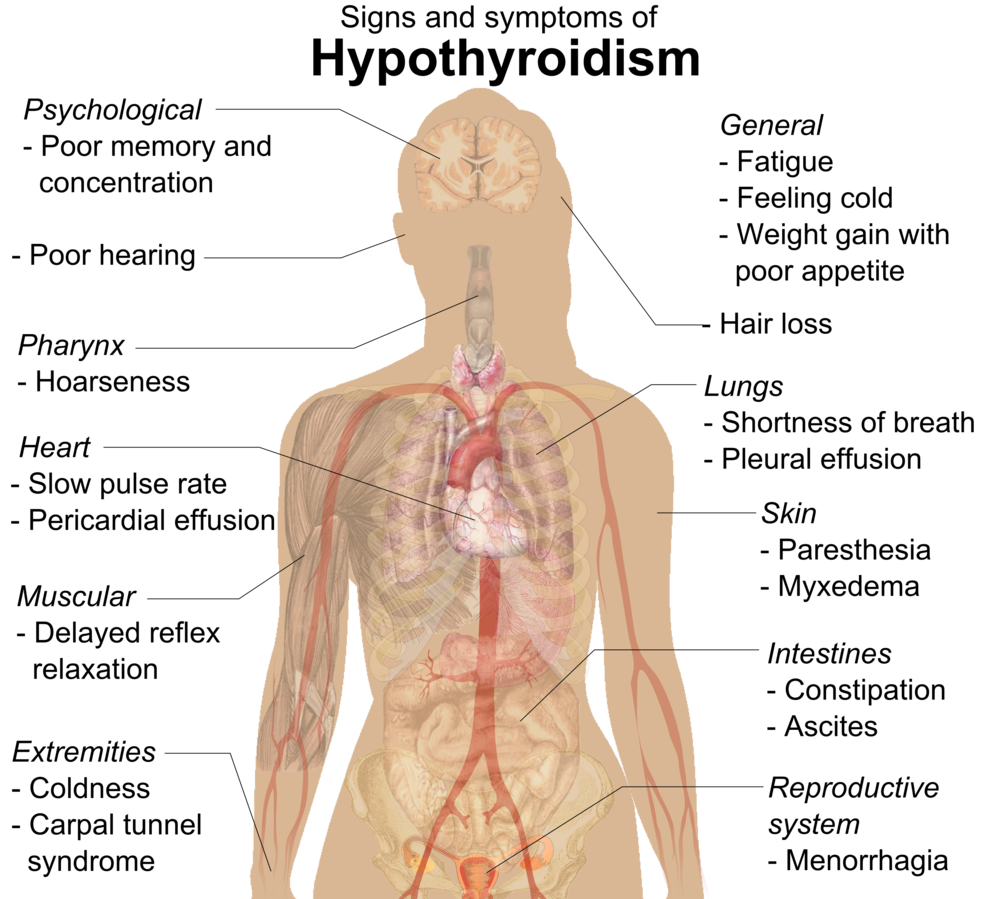 Hypothyroidism