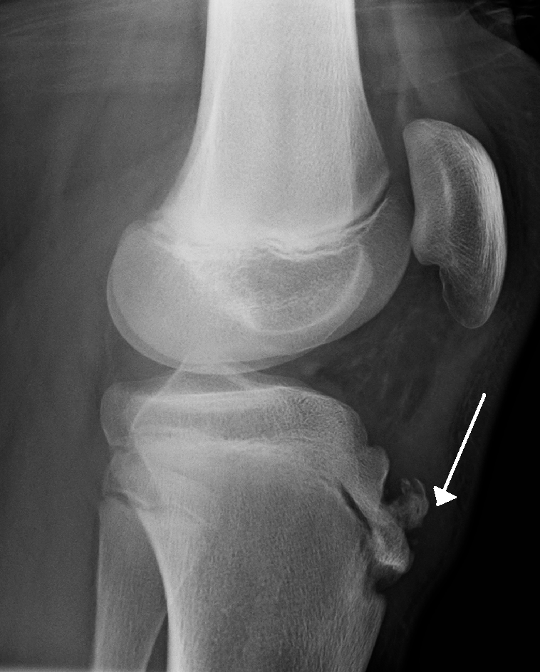 Osgood Schlatter