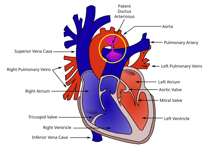 Patent ductus arteriosus