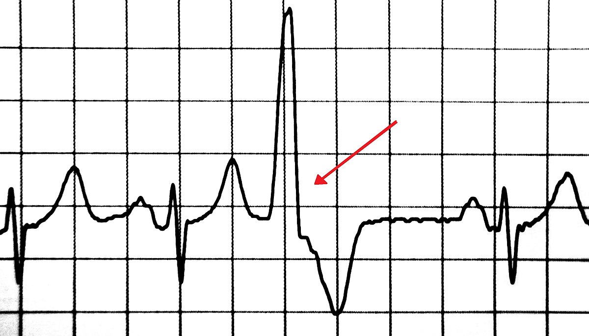 Preventricular contraction