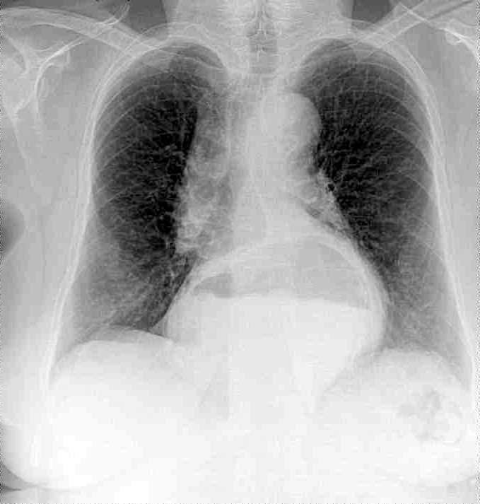 Radiograph of lungs