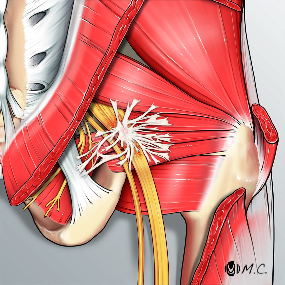 Sciatic nerve entrapment