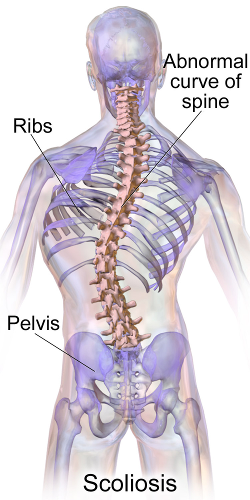 Scolosis