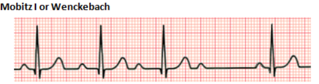 Second degree Mobitz 1 AV heart block