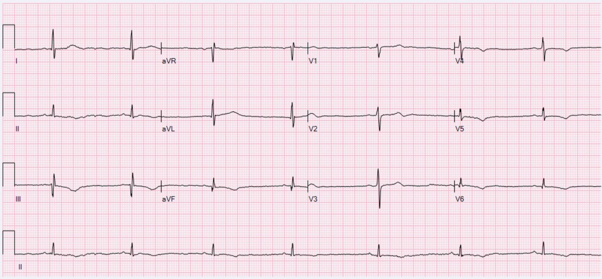 Sinus bradycardia