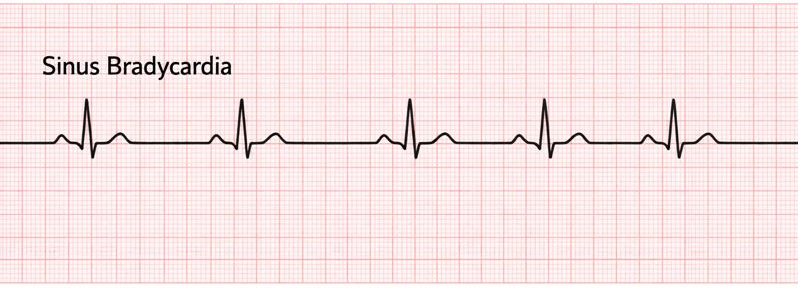 Sinus bradycardia