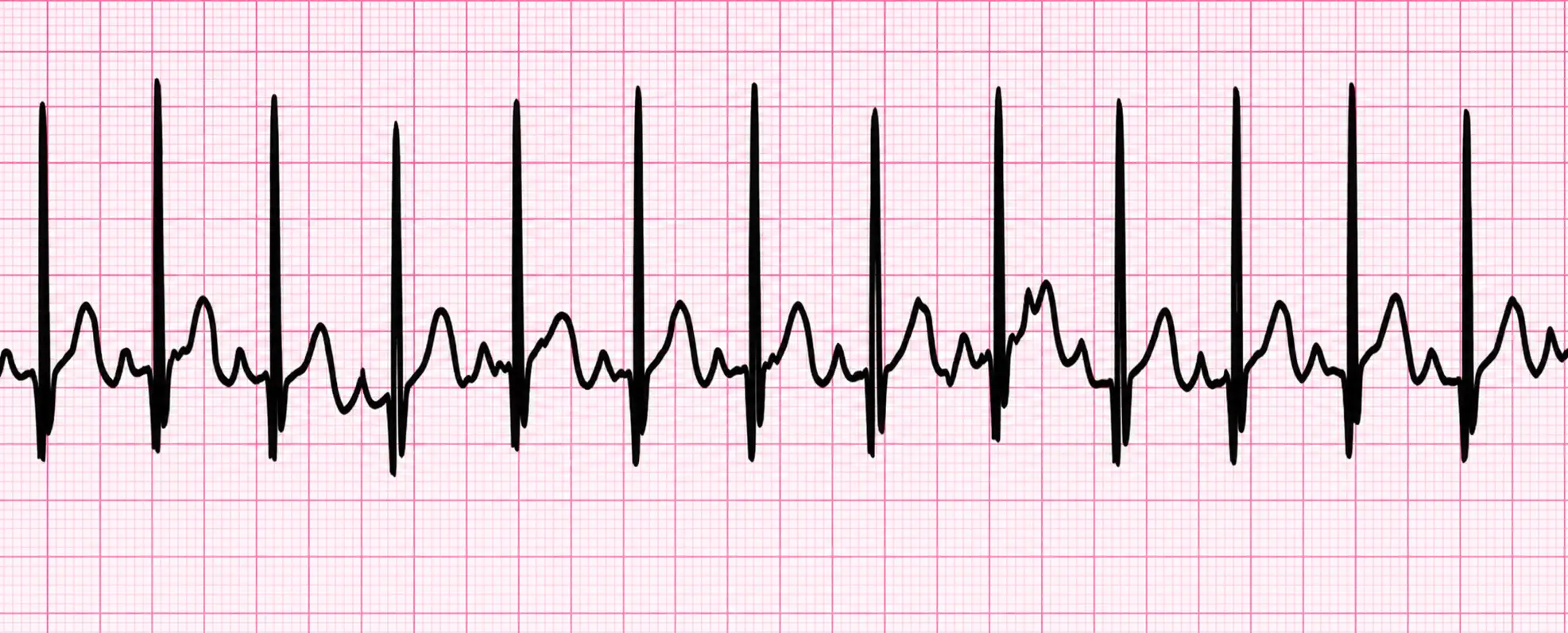 ECG strip showing sinus tachycardia