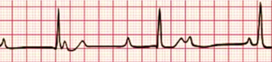 Third degree AV heart block