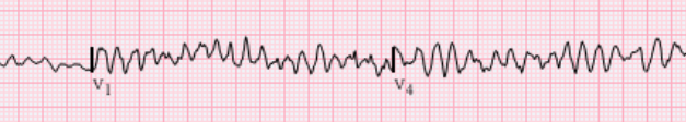 Ventricular fibrillation