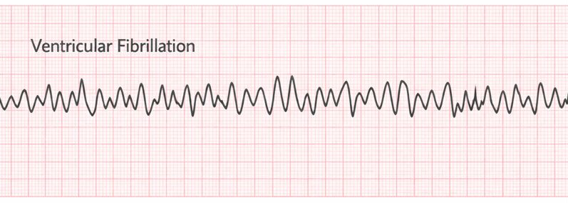 Ventricular fibrillation