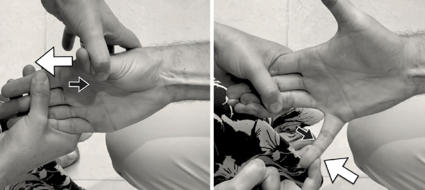 Wrist hyperabduction and abduction of thumb test (WHAT)