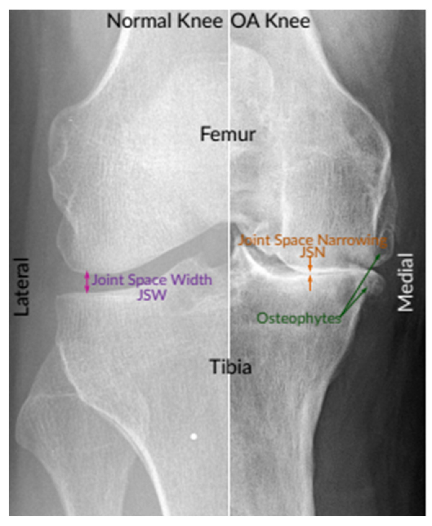 Osteoarthritis of the knee