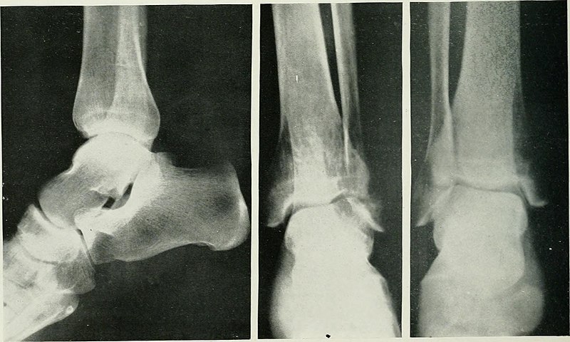 Comparison of normal ankle (on the right) versus osteoporotic ankle, note the cortical thinning and reduced bone density