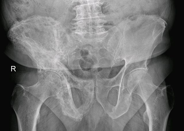 Paget's disease of bone showing multiple lytic and sclerotic areas in the pelvis