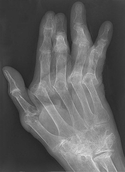 Rheumatoid arthritis of hand showing severe joint erosions, joint space narrowing , osteopenia and deformities