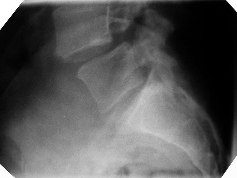 Spondylolisthesis